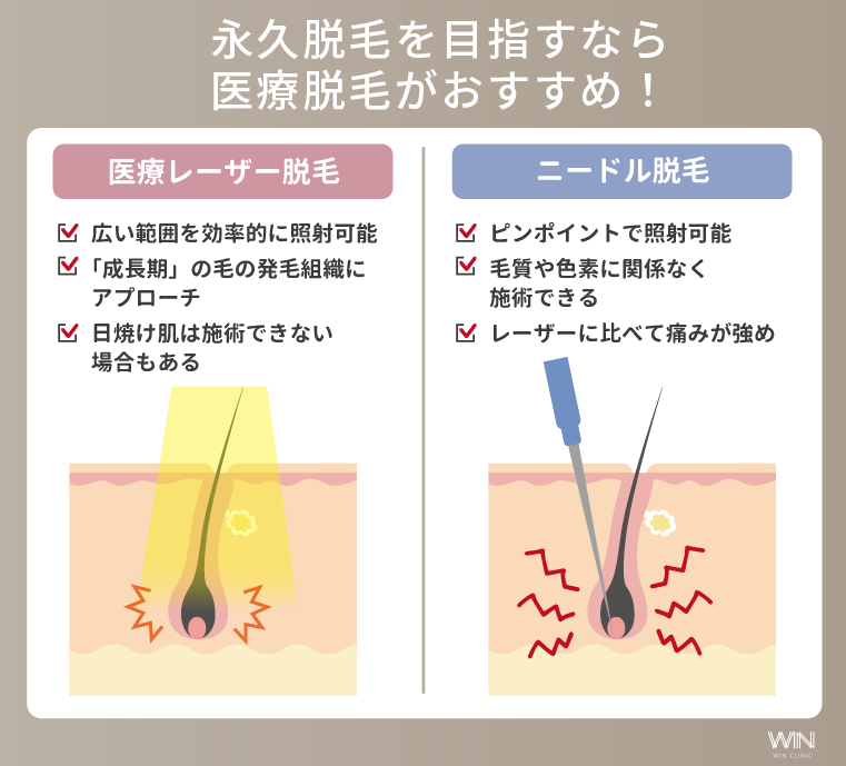 永久脱毛を目指すなら医療脱毛がおすすめ！
