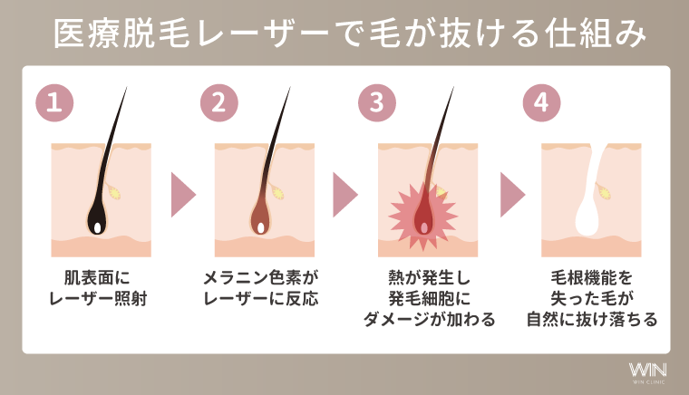 医療脱毛レーザーで毛が抜ける仕組み