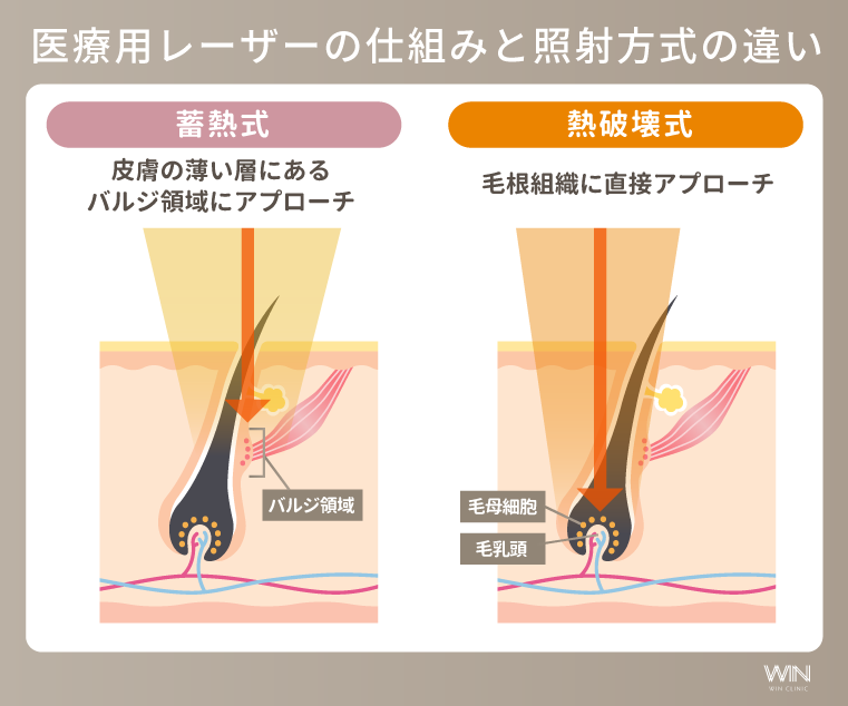 医療用レーザーの仕組みと照射方式の違い